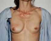 Feel Beautiful - Breast Revision San Diego 6 - Before Photo